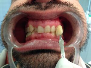 Blanqueamiento Dental en San Pedro de Alcántara | Clínica dental Ana Moreno