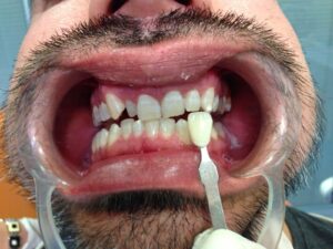 Blanqueamiento Dental en San Pedro de Alcántara | Clínica dental Ana Moreno