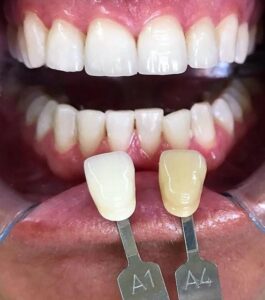 Blanqueamiento Dental en San Pedro de Alcántara | Clínica dental Ana Moreno