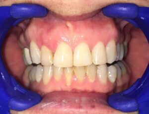 Blanqueamiento Dental en San Pedro de Alcántara | Clínica dental Ana Moreno