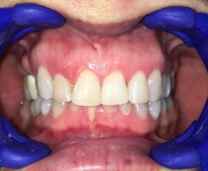 Blanqueamiento Dental en San Pedro de Alcántara | Clínica dental Ana Moreno