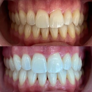 Blanqueamiento Dental en San Pedro de Alcántara | Clínica dental Ana Moreno