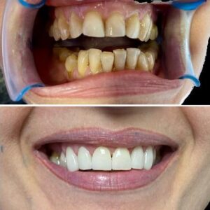 Estética Dental en san Pedro de Alcántara | Clínica dental Ana Moreno