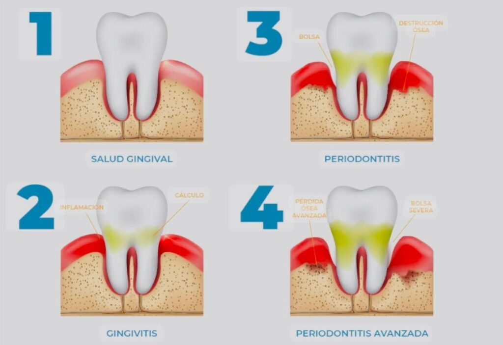 Periodoncia en San Pedro de Alcántara - Clinica Dental Ana Moreno