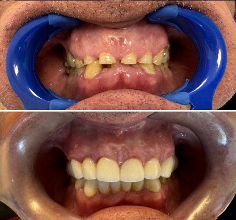 Rehabilitación Oral en San Pedro de Alcántara - Clinica Dental Ana Moreno